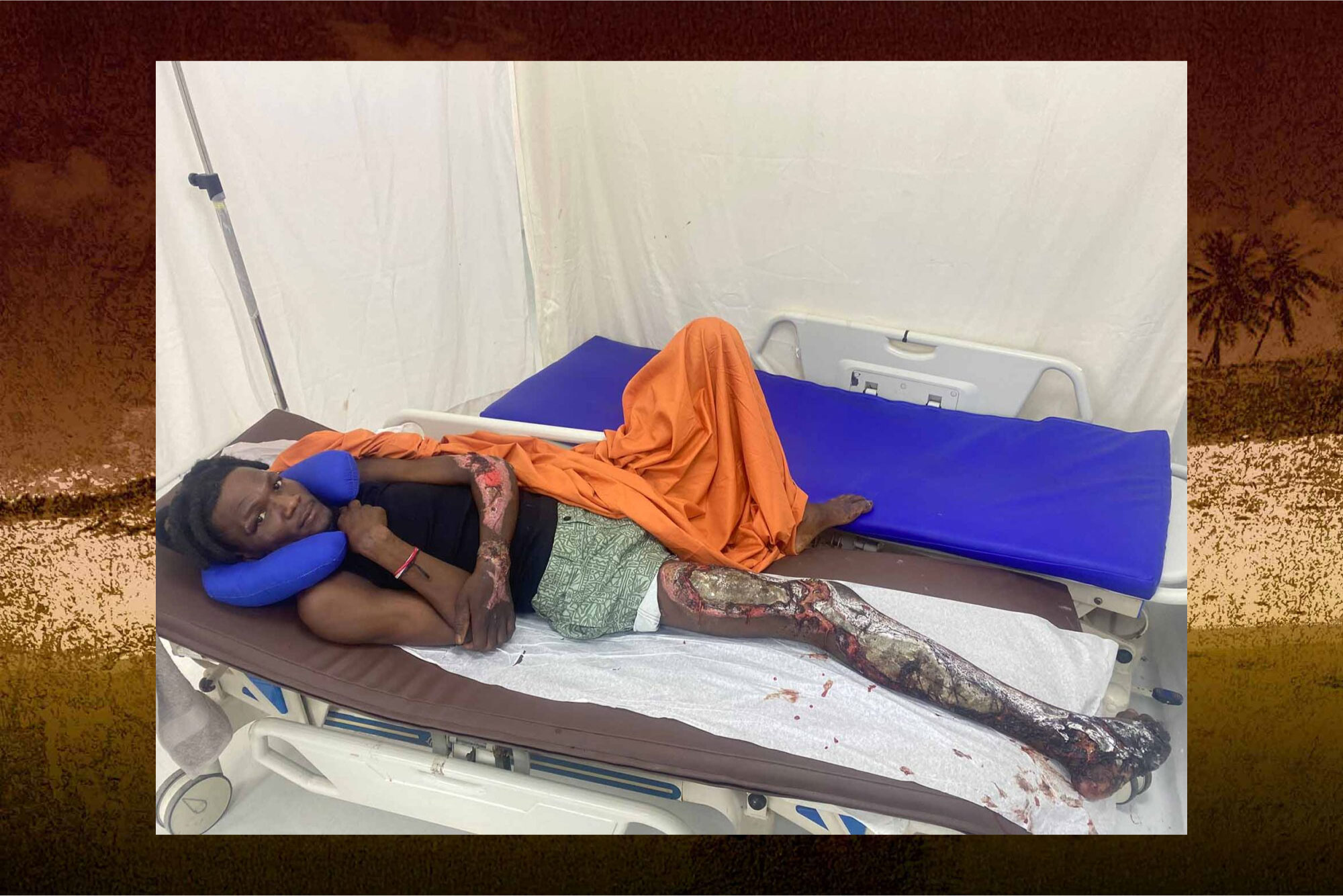 Wikey was dragged by a pickup truck. After 17 days hiding in his home, the Haitian support network arranged for him to get a hospital bed.