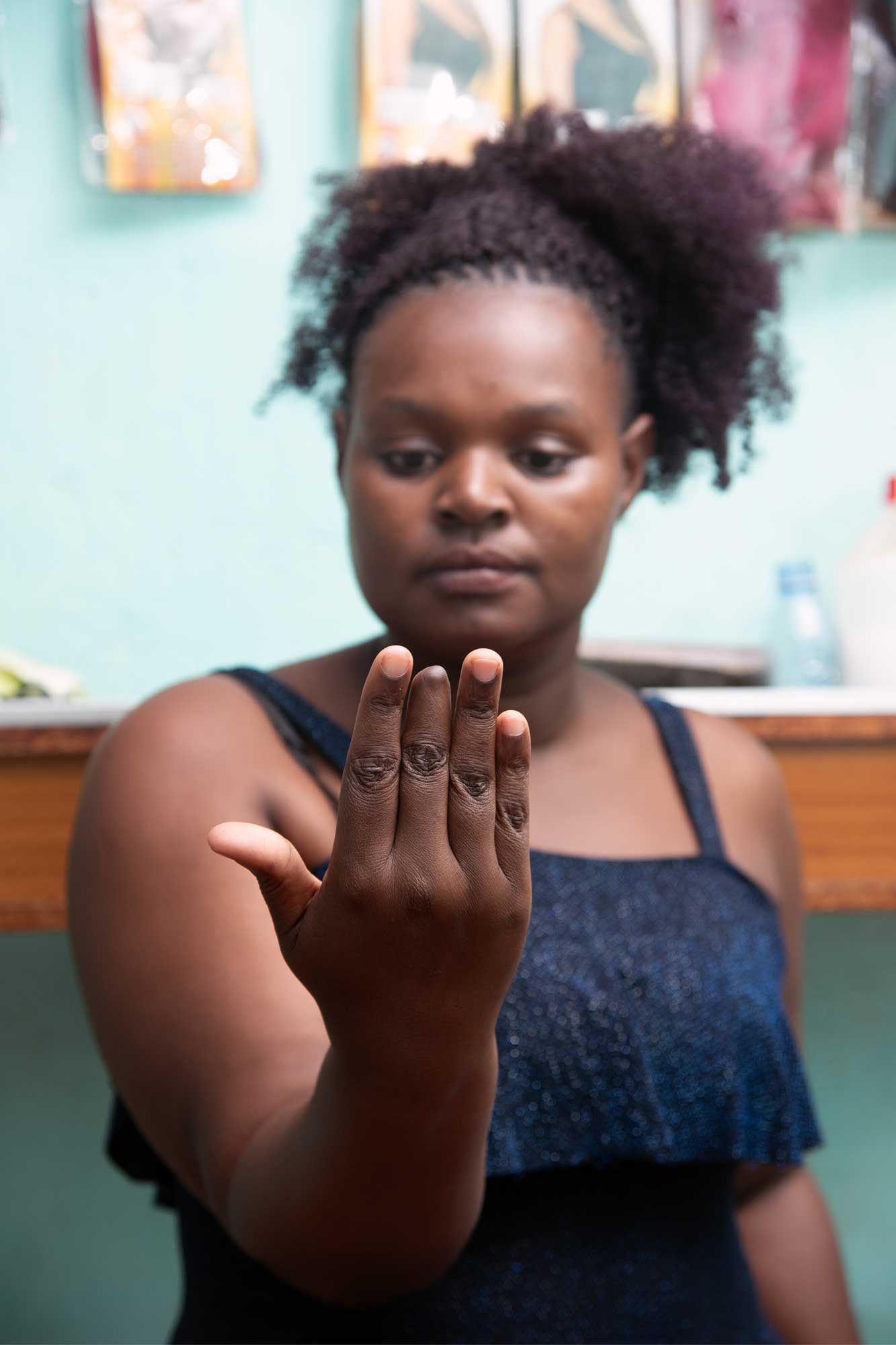 Sharon Kusasira's middle finger was partially amputated because of the toxic chemicals she had to use during her work. Photo courtesy of Culton Scovia Nakamya.